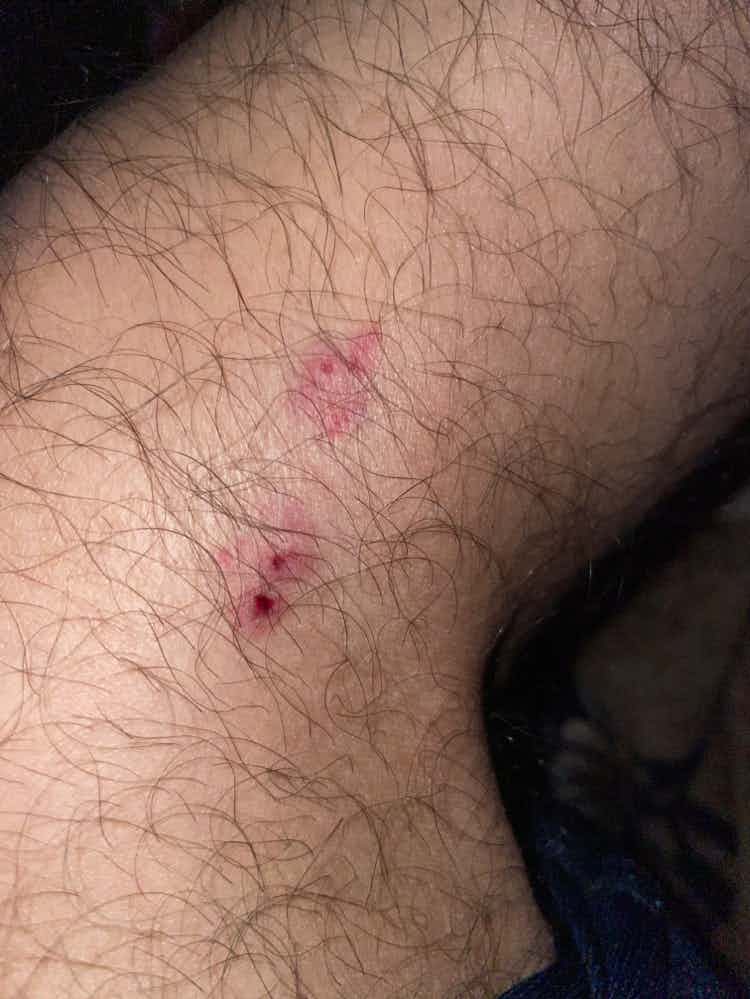 I got bitten by my 4 month old german some blood came but there is no bleeding now what should i do. He is fully vaccinated.