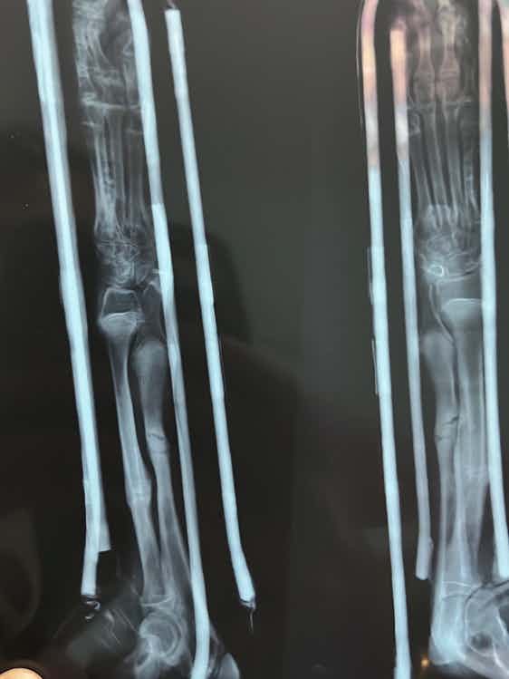 My puppy broke his arm on 5th March. Below if the X-ray from 22nd March and 2nd April. Can you tell me if he is healing well